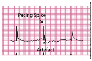 A graph showing a normal heart rate

AI-generated content may be incorrect.