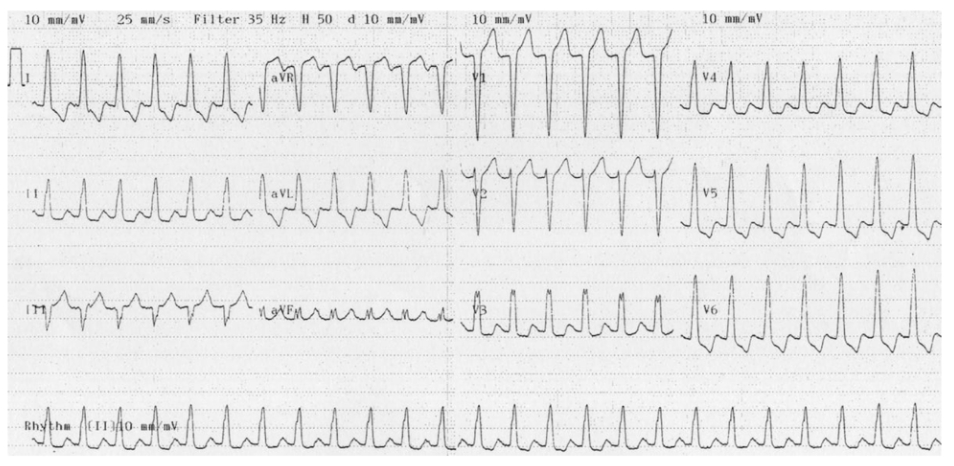 SVT with LBBB