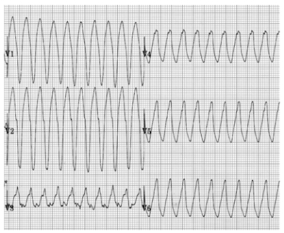 Ventricular Tachycardia